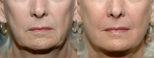 laser terapia aurretik eta ondoren