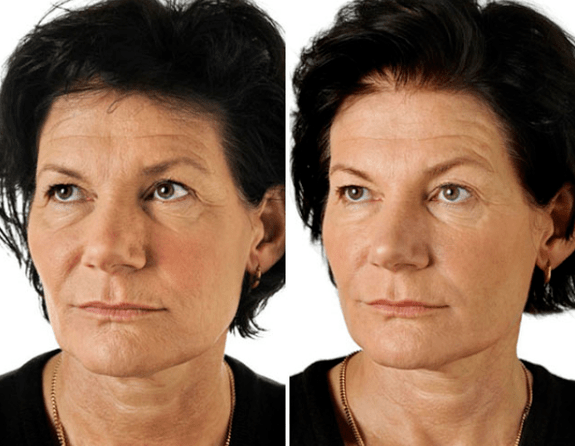 Aurpegiaren gaztetze zatikiaren emaitza