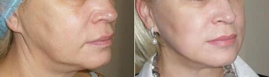 Argazkia prozedura aplikatu ondoren