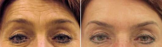 Eremu kopetaren gaztetzea